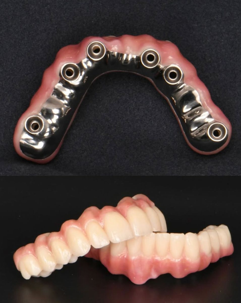 Armature sur implants et bridge fini