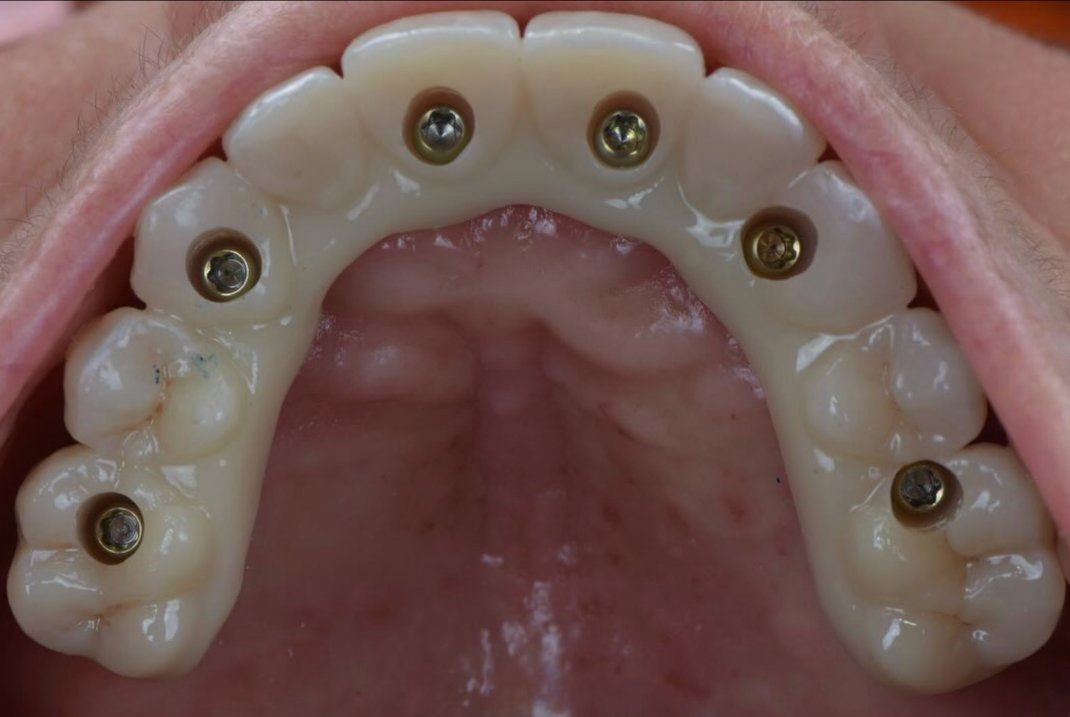 Restauration finale sur implants