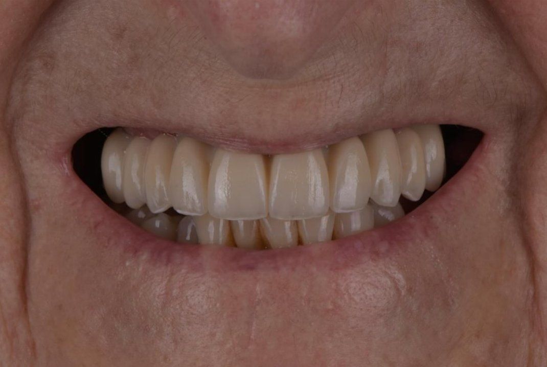 Sourire final